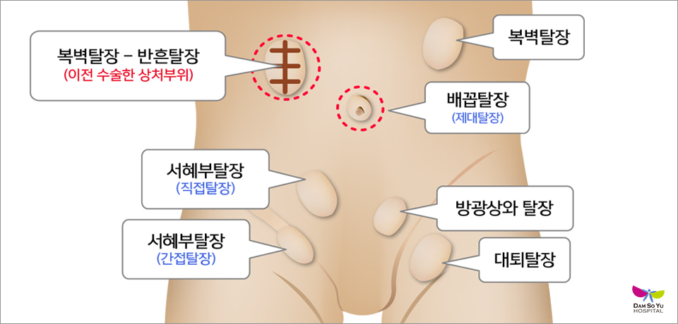 탈장 진단 및 치료법