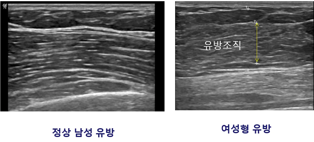 정상 남성 유방과 여성형 유방의 유방조직을 비교한 초음파 영상